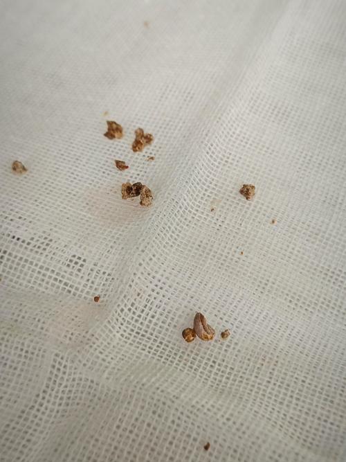 孕期肾积水合并输尿管结石怎么办？对胎儿有影响吗？-第2张图片-郑州医学网