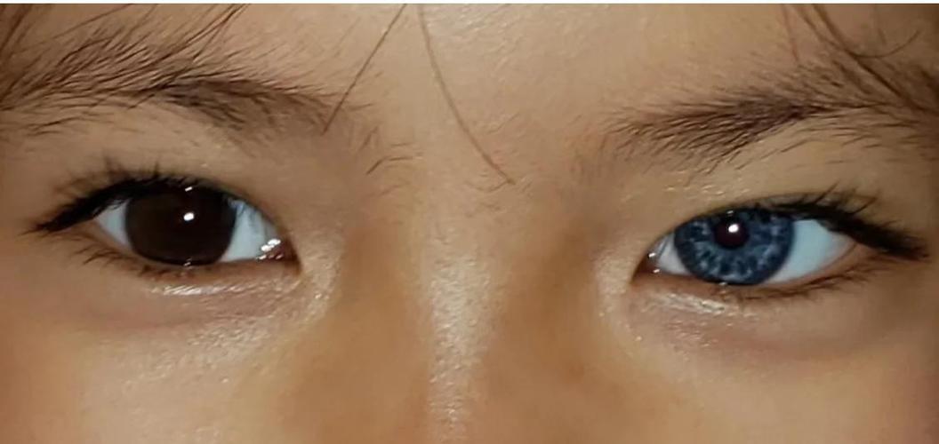 新生儿黑眼球发灰是正常现象吗？需要警惕哪些眼部问题？-第1张图片-郑州医学网