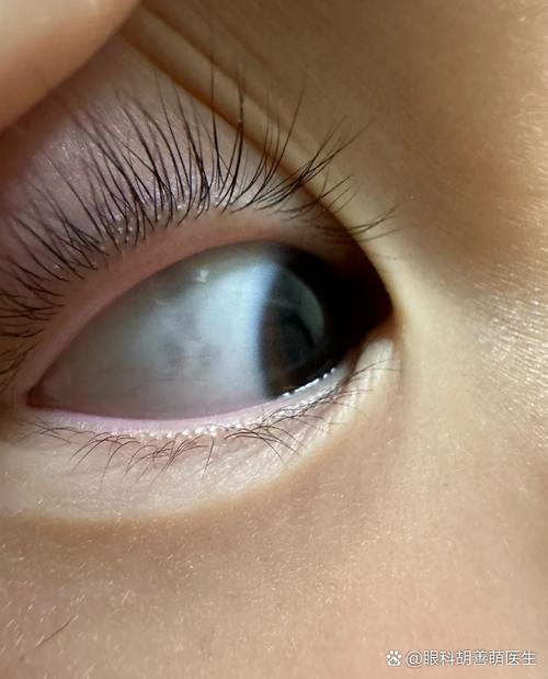 新生儿黑眼球发灰是正常现象吗？需要警惕哪些眼部问题？-第2张图片-郑州医学网