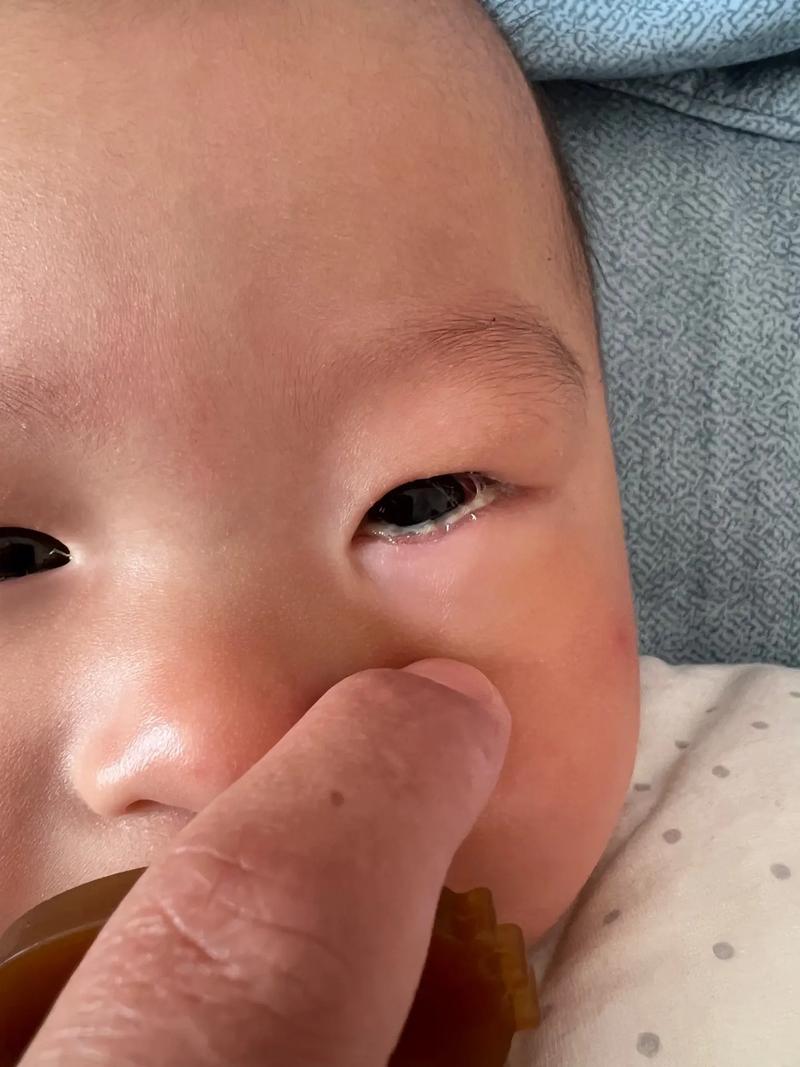 新生儿黑眼球发灰是正常现象吗？需要警惕哪些眼部问题？-第3张图片-郑州医学网