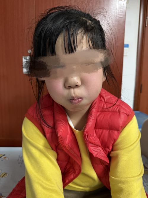 新生儿面瘫症怎么治疗？有哪些安全有效的治疗方法？-第1张图片-郑州医学网