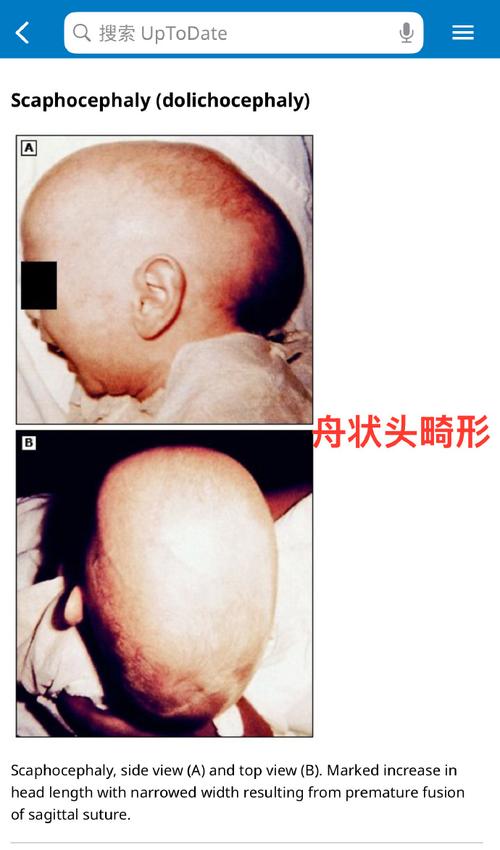 新生儿脑密度低会有哪些具体症状？家长该如何早期识别与应对？-第1张图片-郑州医学网