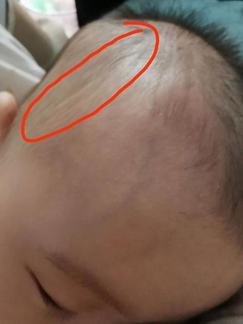 新生儿脑密度低会有哪些具体症状？家长该如何早期识别与应对？-第3张图片-郑州医学网