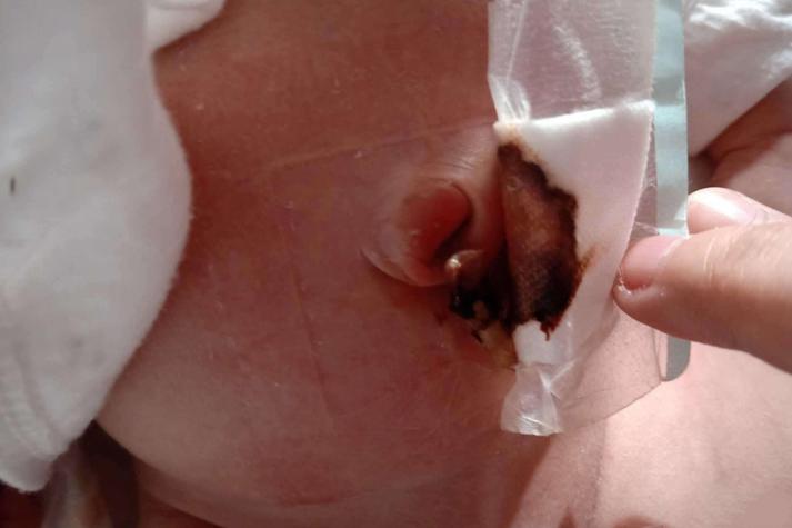 新生儿肚脐眼红肿图片正常吗？需要就医处理吗？-第1张图片-郑州医学网