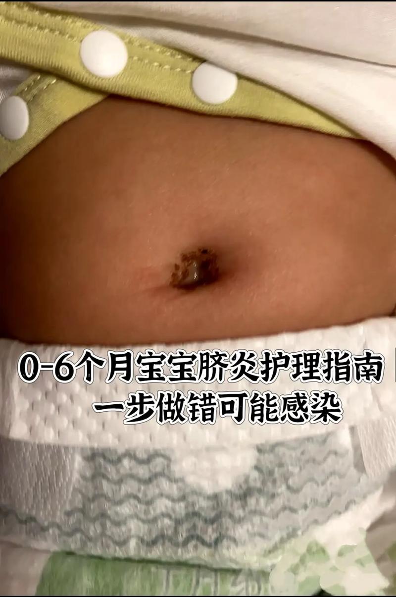 新生儿肚脐眼红肿图片正常吗？需要就医处理吗？-第2张图片-郑州医学网