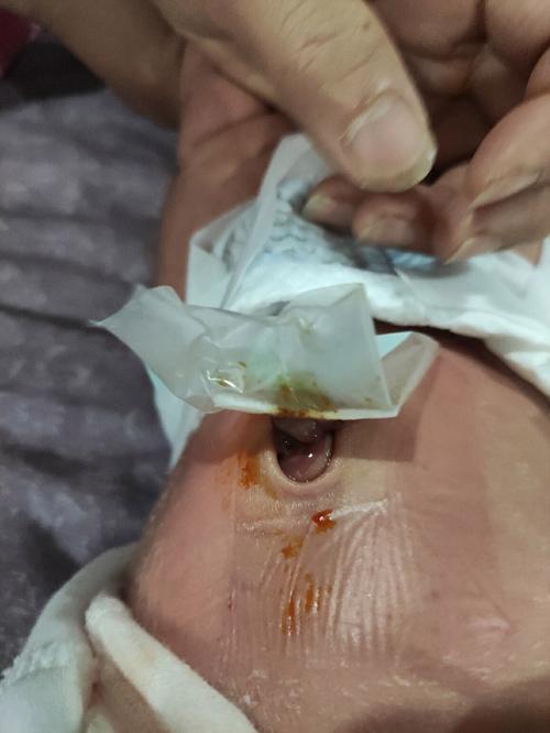 新生儿肚脐眼红肿图片正常吗？需要就医处理吗？-第3张图片-郑州医学网