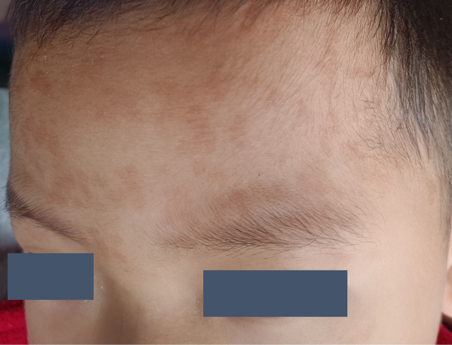 新生儿额头红斑会自行消退吗？需要治疗吗？家长该如何护理？-第2张图片-郑州医学网