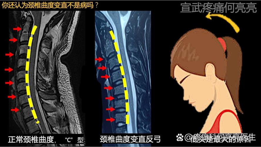 孩子颈椎生理曲度变直是怎么回事？会对身体造成哪些危害？-第2张图片-郑州医学网