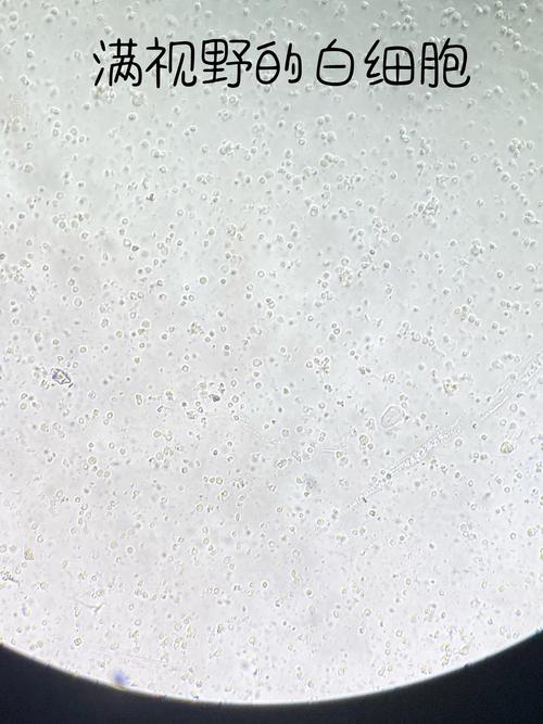 孕期尿检白细胞170严重吗？需要治疗吗？对胎儿有影响吗？-第1张图片-郑州医学网