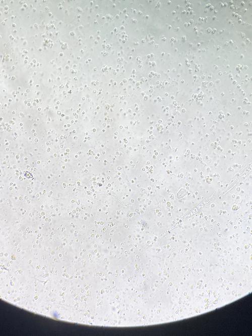 孕期尿检白细胞170严重吗？需要治疗吗？对胎儿有影响吗？-第2张图片-郑州医学网