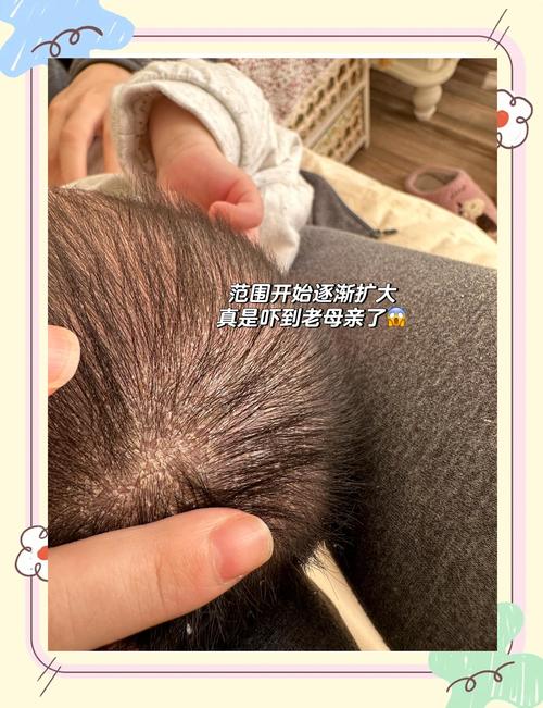儿童头皮屑多怎么处理？日常护理和饮食调整需要注意什么？-第2张图片-郑州医学网
