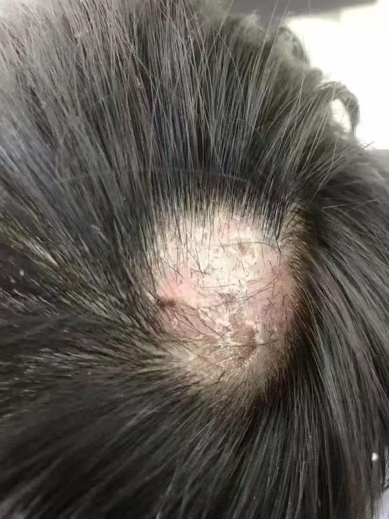 儿童头皮屑多怎么处理？日常护理和饮食调整需要注意什么？-第3张图片-郑州医学网