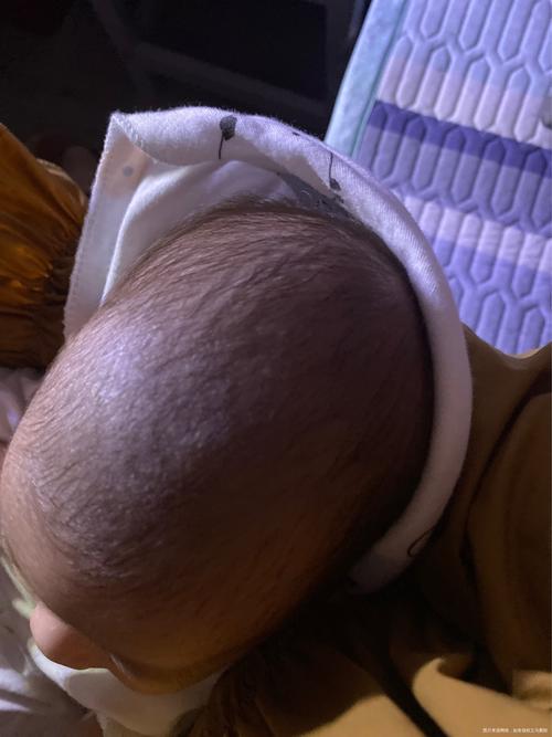 新生儿前囟门头发稀少是缺钙还是正常现象？-第1张图片-郑州医学网