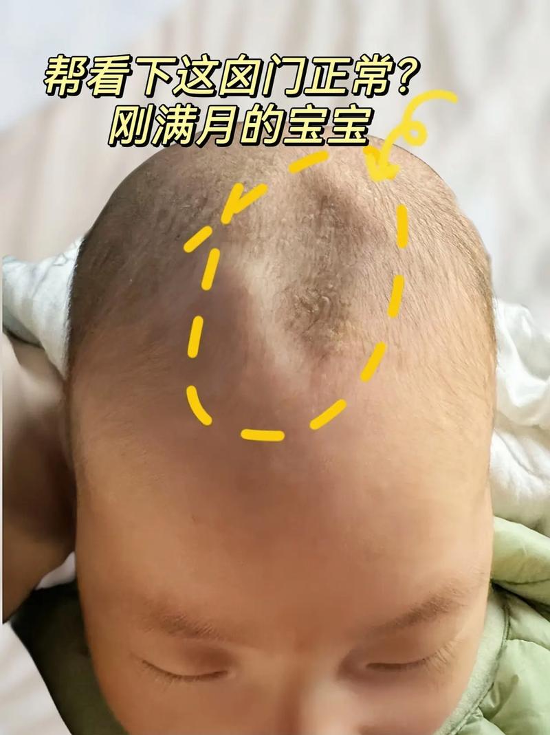新生儿前囟门头发稀少是缺钙还是正常现象？-第2张图片-郑州医学网