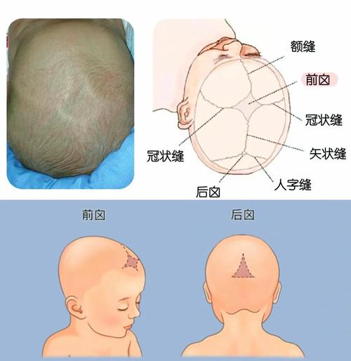 新生儿前囟门头发稀少是缺钙还是正常现象？-第3张图片-郑州医学网