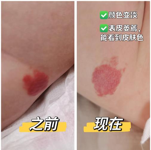新生儿毛细血管扩张图能直接确诊疾病吗？不同部位扩张形态有何临床意义？-第2张图片-郑州医学网