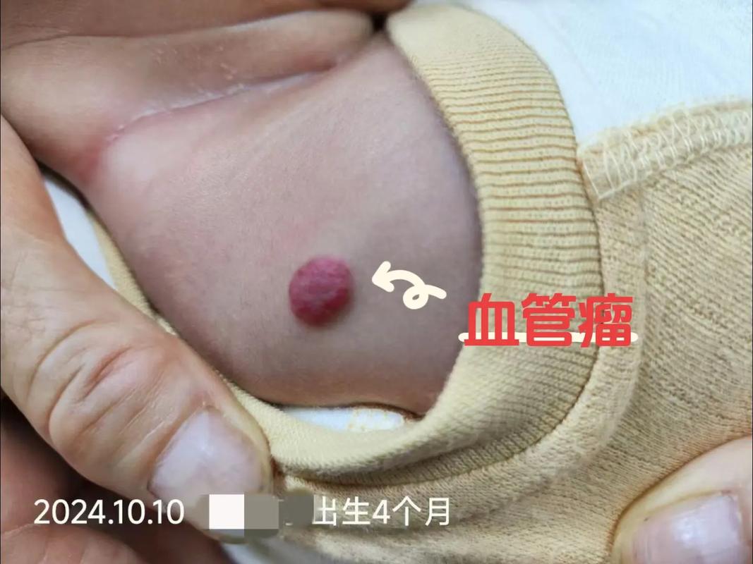 新生儿毛细血管扩张图能直接确诊疾病吗？不同部位扩张形态有何临床意义？-第3张图片-郑州医学网