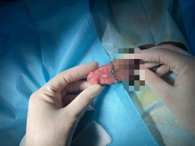 美国新生儿割包皮图片背后，涉及哪些伦理争议与文化差异？-第1张图片-郑州医学网