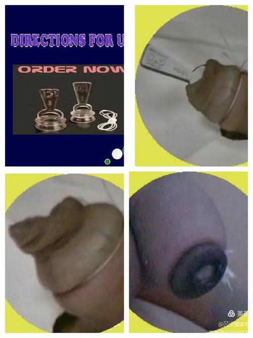 美国新生儿割包皮图片背后，涉及哪些伦理争议与文化差异？-第3张图片-郑州医学网