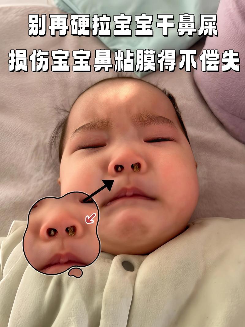 新生儿长鼻屎是正常现象还是生病信号？家长该如何正确处理？-第1张图片-郑州医学网