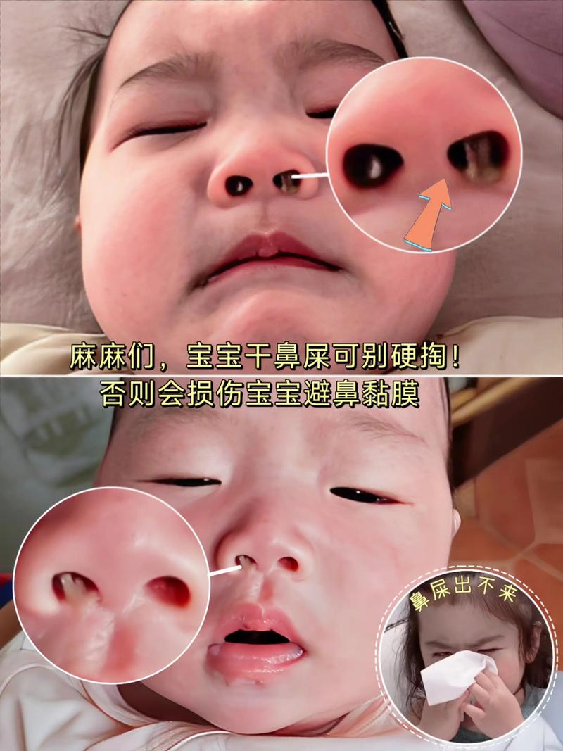 新生儿长鼻屎是正常现象还是生病信号？家长该如何正确处理？-第2张图片-郑州医学网
