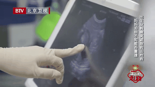 新生儿膈疝手术后的复发率究竟有多高？家长该如何科学应对与预防？-第3张图片-郑州医学网