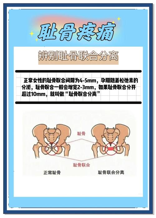 孕期耻骨分离怎么检查？需要做哪些检查项目？-第3张图片-郑州医学网