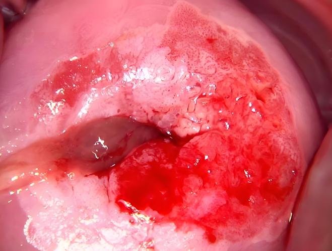 孕期宫颈息肉持续出血，会对胎儿造成不良影响吗？该如何有效处理？-第2张图片-郑州医学网