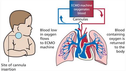 新生儿肺功能发育不良的成因、干预与预后如何？-第3张图片-郑州医学网