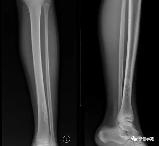 儿童纤维性骨皮质缺损到底是什么病？家长必须了解的成因、症状与治疗全攻略-第2张图片-郑州医学网