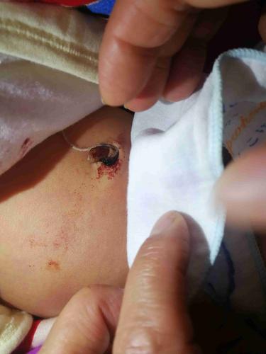 新生儿十一天肚脐出血是正常现象还是异常信号？该如何正确处理？-第1张图片-郑州医学网