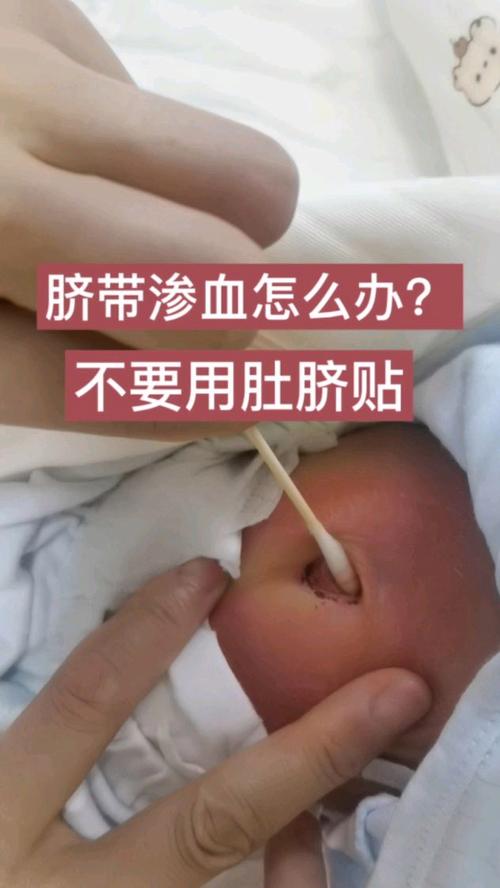 新生儿十一天肚脐出血是正常现象还是异常信号？该如何正确处理？-第2张图片-郑州医学网