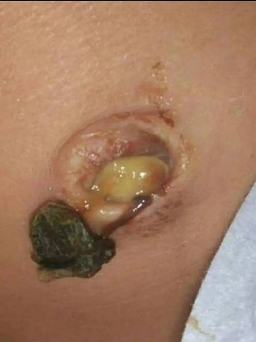 新生儿十一天肚脐出血是正常现象还是异常信号？该如何正确处理？-第3张图片-郑州医学网