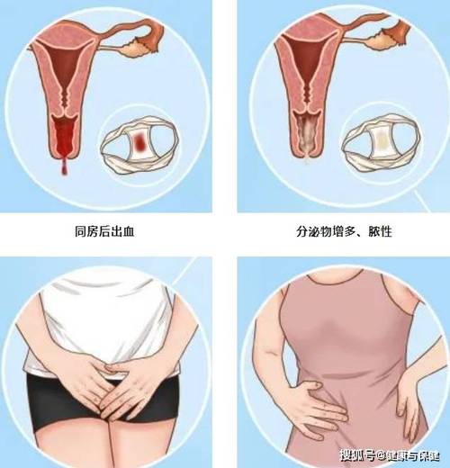 孕期外阴胀痛难忍？有哪些安全有效的缓解方法？-第2张图片-郑州医学网