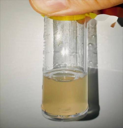 新生儿吸入胎粪后，如何判断风险并正确处理？-第2张图片-郑州医学网