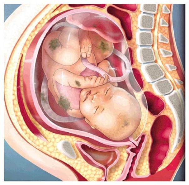 新生儿吸入胎粪后，如何判断风险并正确处理？-第3张图片-郑州医学网