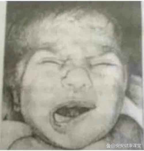 新生儿哭时嘴巴歪是正常现象还是异常信号？需警惕哪些潜在问题？-第1张图片-郑州医学网