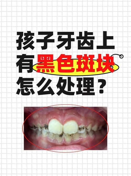 儿童牙齿长出难看黄斑，到底用什么方法才能彻底去除？-第1张图片-郑州医学网