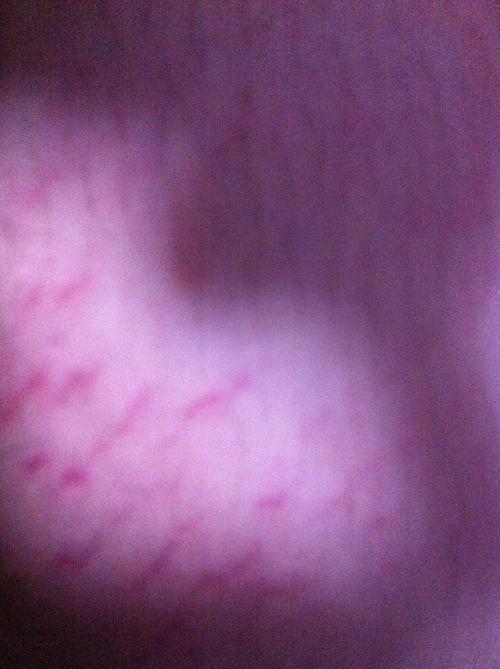 孕期肚子上有紫色血丝-第2张图片-郑州医学网