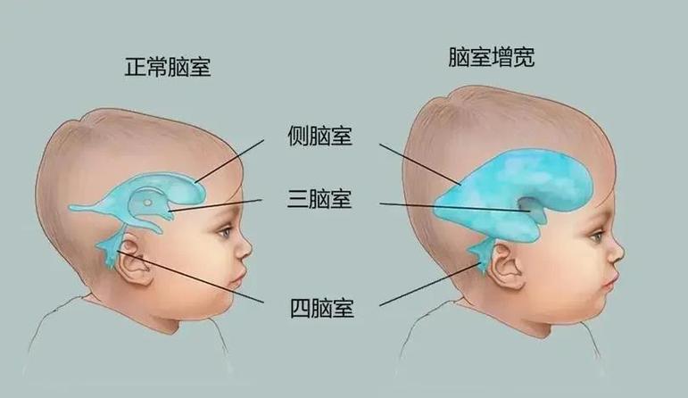 新生儿脑密度低是发育未成熟的表现吗？会影响后续成长吗？-第1张图片-郑州医学网