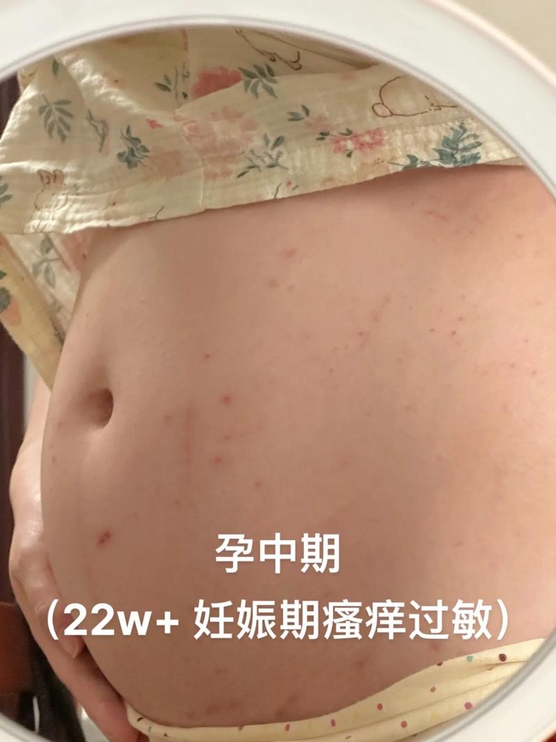 孕期炎症会有哪些症状-第1张图片-郑州医学网