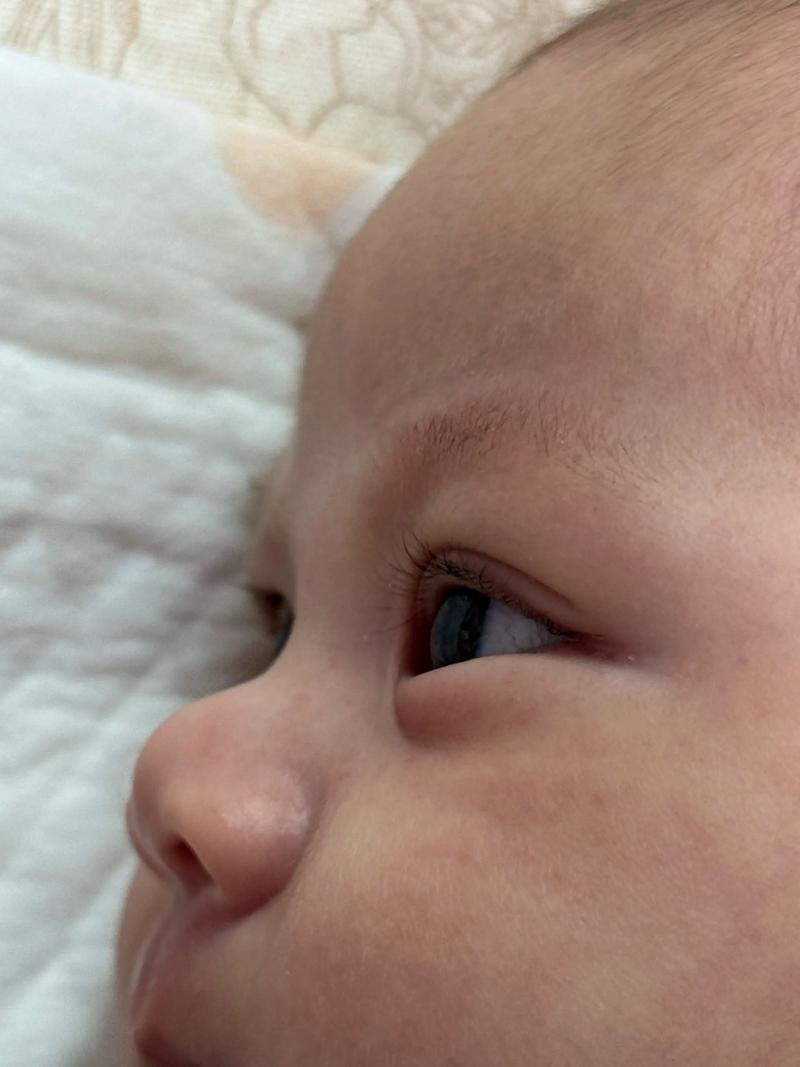 新生儿一只眼睛睁不开是先天畸形还是生理性水肿？需立即就医排查吗？-第3张图片-郑州医学网