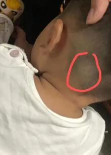 新生儿头皮里的疙瘩是正常生理现象还是疾病信号？需要警惕吗？-第2张图片-郑州医学网
