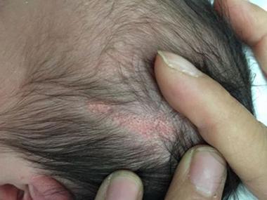 新生儿头皮里的疙瘩是正常生理现象还是疾病信号？需要警惕吗？-第3张图片-郑州医学网