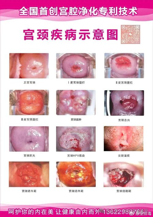 孕期宫颈糜烂会有哪些症状表现？会对胎儿造成影响吗？-第1张图片-郑州医学网