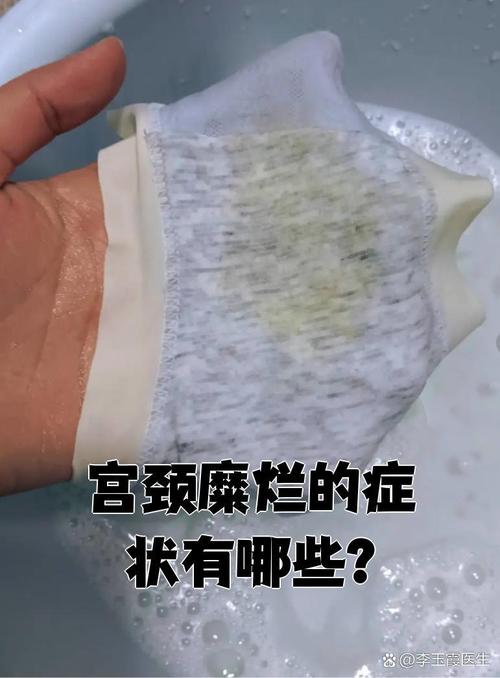 孕期宫颈糜烂会有哪些症状表现？会对胎儿造成影响吗？-第2张图片-郑州医学网