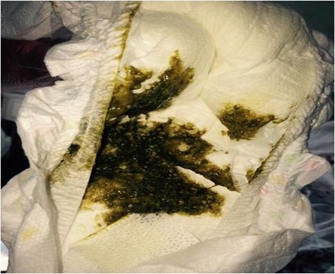 新生儿吸入胎粪的症状-第1张图片-郑州医学网