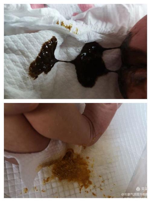 新生儿吸入胎粪的症状-第3张图片-郑州医学网