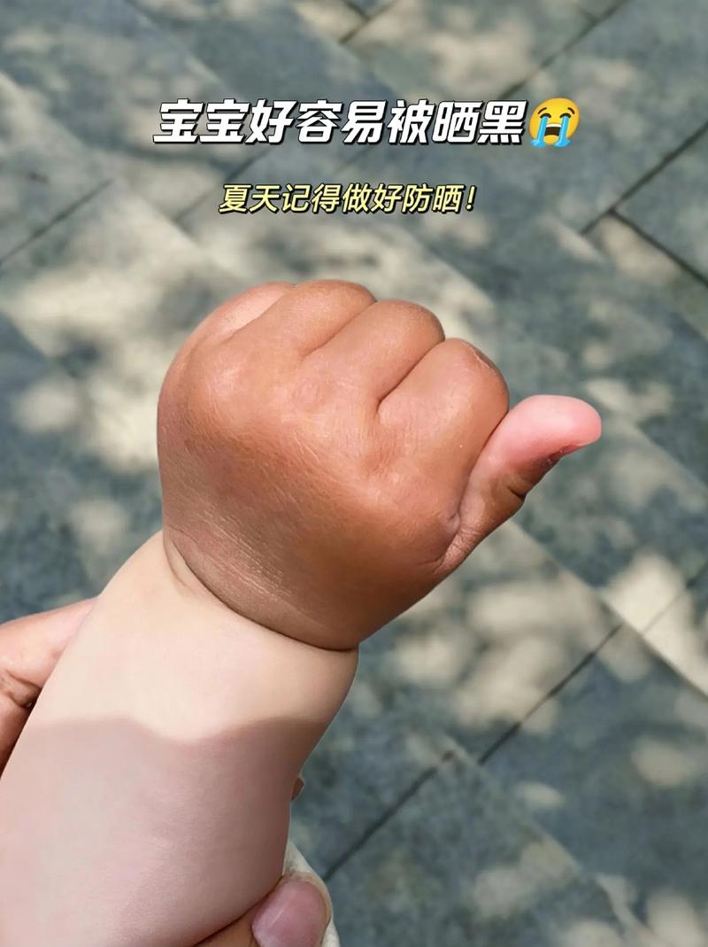 新生儿肤色突然变深是正常现象吗？需警惕哪些健康问题？-第2张图片-郑州医学网