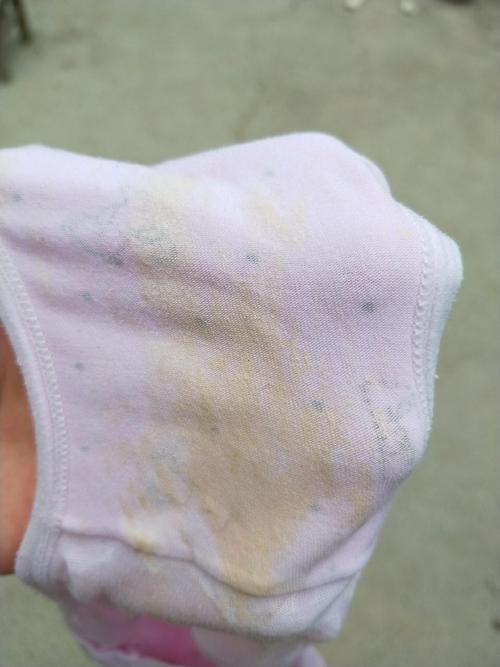 孕期内裤湿一小块是正常分泌物还是异常漏羊水？附图片如何判断？-第1张图片-郑州医学网